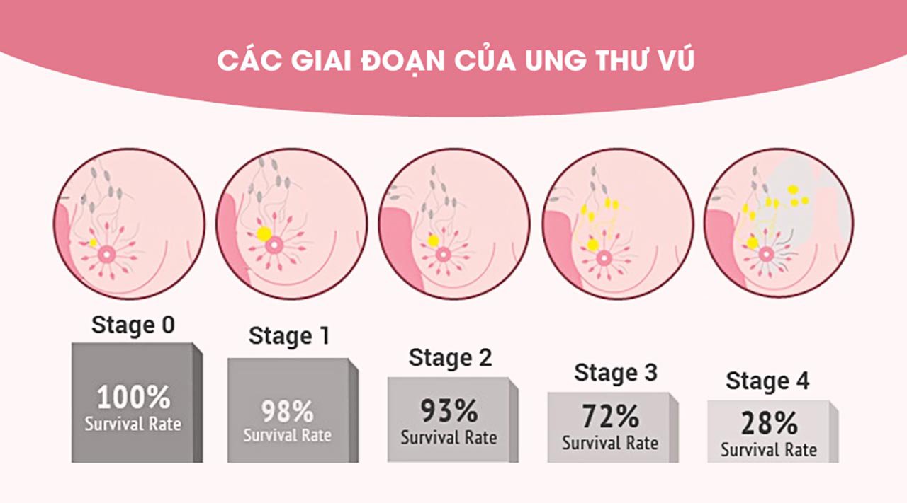 Các giai đoạn ung thư vú